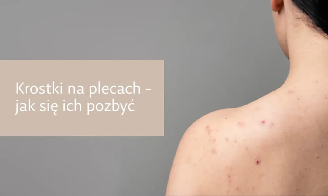 Pryszcze na plecach od czego? Odkryj przyczyny i skuteczne rozwiązania Pryszcze na plecach od czego? Odkryj przyczyny i skuteczne rozwiązania